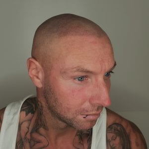Scalp Micropigmentation After