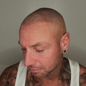 Scalp Micropigmentation After