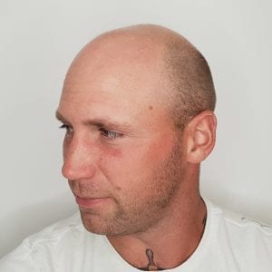 Scalp Micropigmentation Before