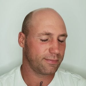 Scalp Micropigmentation Before