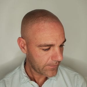 After Scalp Micropigmentation