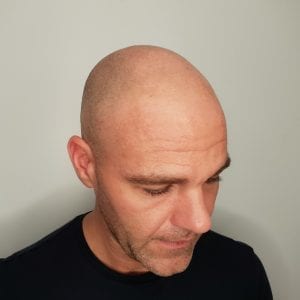 Before Scalp Micropigmentation