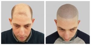 Scalp Micropigmentation Before & After Results
