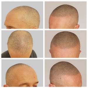 Scalp Micropigmentation Hairline Restoration