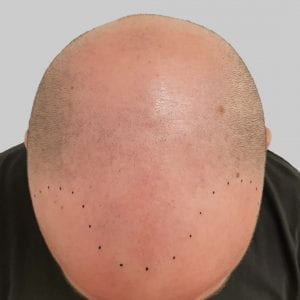 Scalp Micropigmentation Before